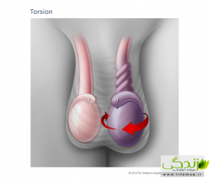 پیچش بیضه از تشخیص تا درمان