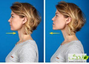 با سریعترین روش های رفع غبغب آشنا شوید ! به روز رسانی شد