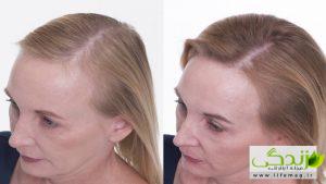 آیا شانه لیزری برای رشد مو موثر است؟