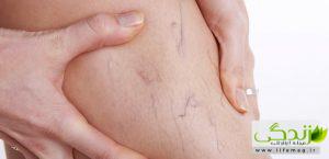 تمامی روش های موثر در درمان خانگی واریس پا , تخمدان و ناحیه تناسلی